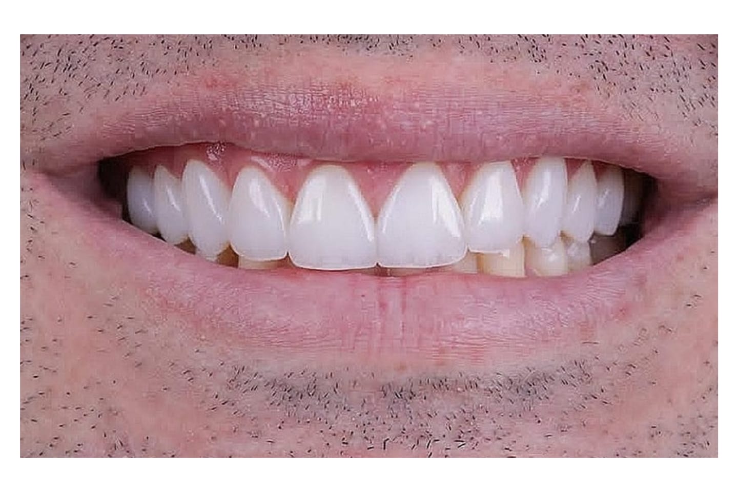 Facetas e lentes de contato