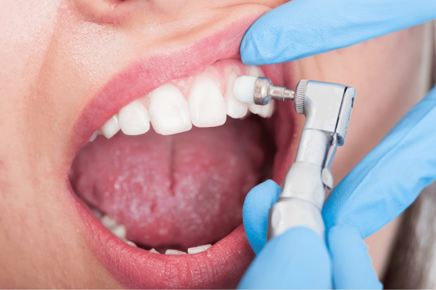 Limpeza Dental